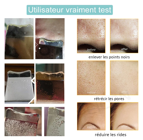 Épurateur de peau à ultrasons, dissolvant de points noirs, nettoyeur de pores